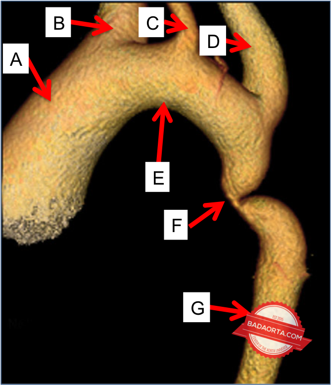 how does aortic coarctation cause radiofemoral delay
