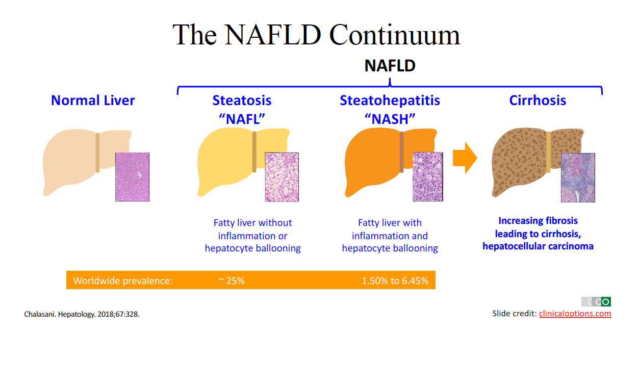 NASH vs. NAFLD Diagnostic and Treatment Implications Dr. Gish